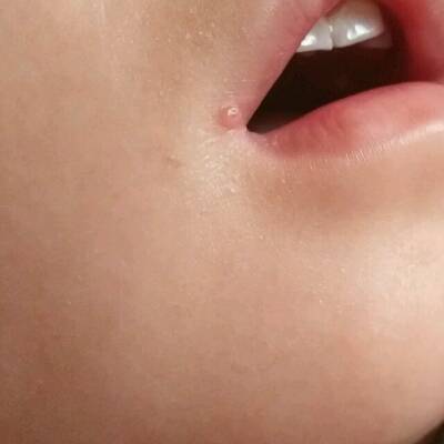 宝宝嘴巴疱疹图片