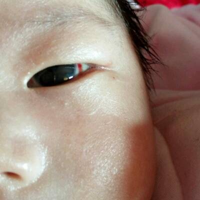 宝宝眼睛被戳充血图片图片