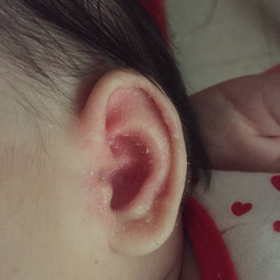 宝宝耳朵旁边长癣图片图片