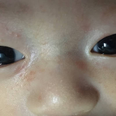 婴儿奶癣早期图片脸上图片