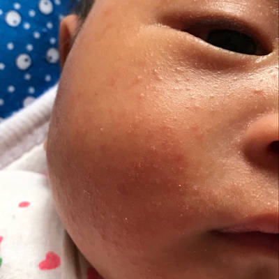 我家宝宝脸上出了许多碎痘痘,现在已经长到额头上了,耳朵上也有,这是