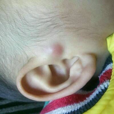 儿童耳朵带状疱疹图片图片