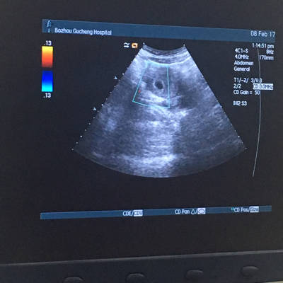 怀孕40天男孩胎囊图片图片
