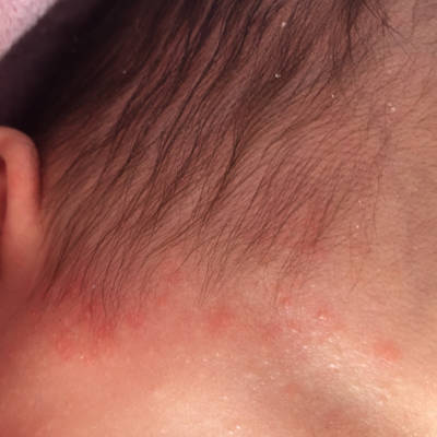 婴幼儿头皮湿疹图片