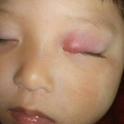 有没有哪位宝宝眼上长过这种东西,昨天去医院开了眼药水和吃的药没