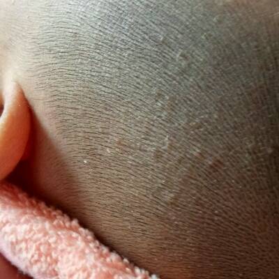 婴儿头皮有小疹子图片图片