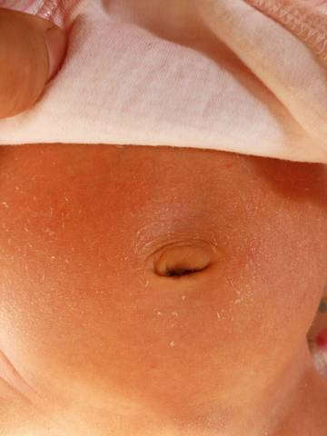 2个月婴儿肚脐正常图图片