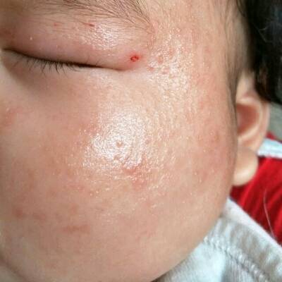 婴儿湿疹刚开始的图片图片