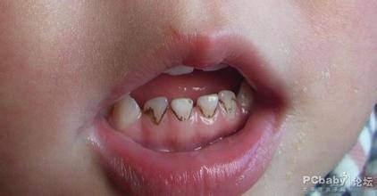 儿科医生介绍,牙齿变黑脱落,有可能是牙釉质发育不全