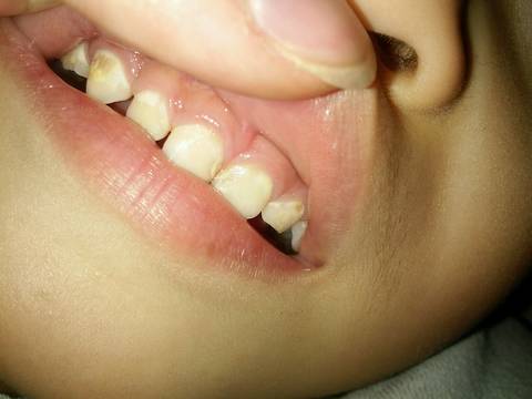 一岁半牙齿腐蚀了,肿么办