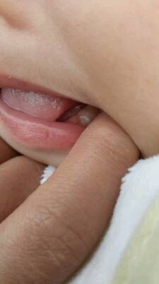 婴儿嘴巴里面长马牙图图片