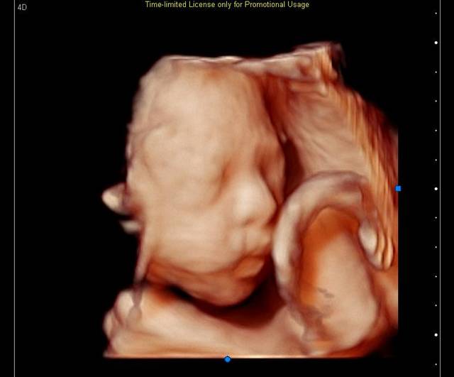 四维彩超五个月胎儿图图片