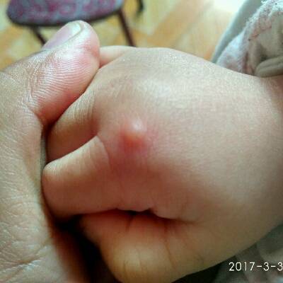 婴儿手上起小疙瘩图片