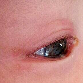 宝宝三个月了,左眼最近突然老流泪,眼眶红肿,眼睛不红,家附近医生开了