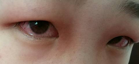 孕期眼睛红肿痒还有很严重的红血丝