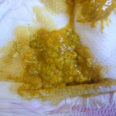 宝宝拉肚子,拉出来的这是什麼呀,有点像痰,还有像白线一样的丝丝
