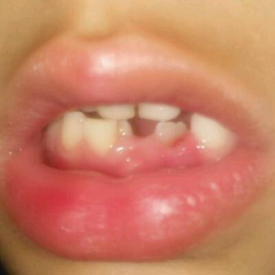 婴儿牙龈长牙齿图片图片