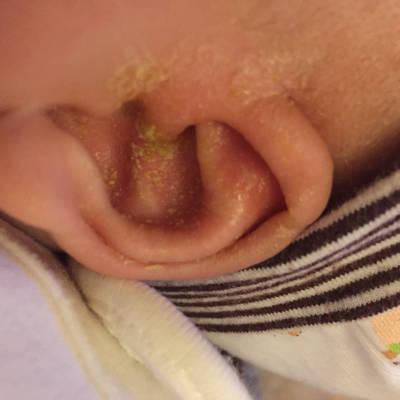 婴儿外耳廓流黄水结痂图片