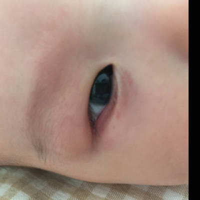 宝宝下眼睑发红图片图片
