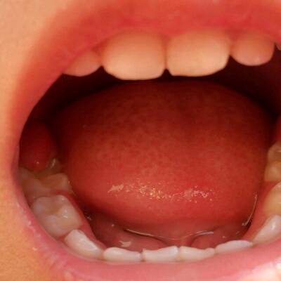 乳牙萌出性囊肿图片图片