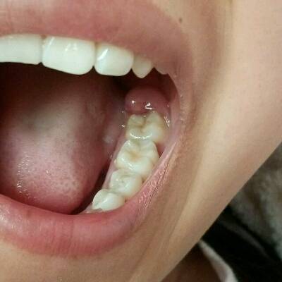 口腔上颚有个牙齿图片