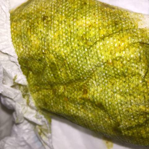 我女儿拉这样的大便为什麼啊?会不会是肠套叠?