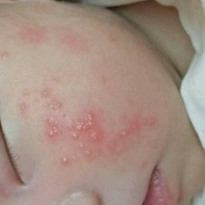 婴儿热疹症状图片图片