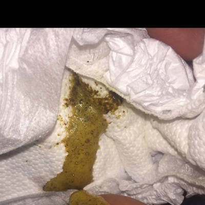 宝宝拉的屎有泡泡,是怎麼回事,消化不良吗?