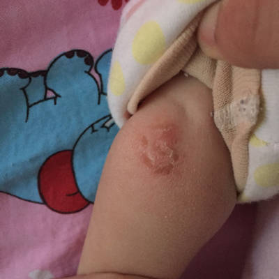 宝宝手臂干性湿疹图片图片