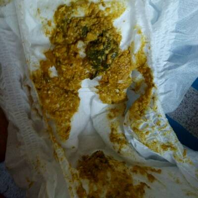 宝宝大便有一坨绿的怎麼回事?