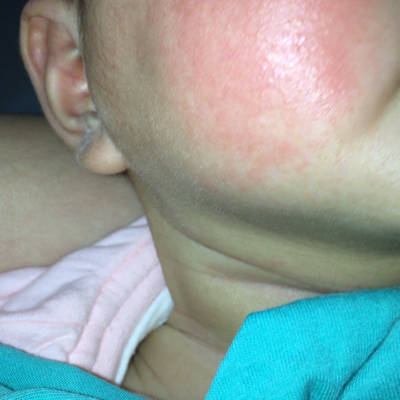 宝宝脸上荨麻疹图片图片