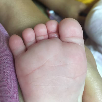 宝宝四个多月,脚趾逢裏面脱皮是怎麼回事?求解