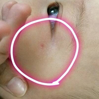 宝宝眼角有一块类似脱皮的