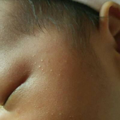 婴儿奶癣早期图片脸上图片