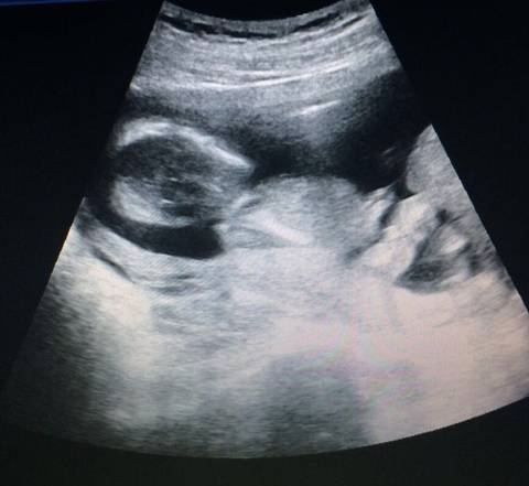 16周胎儿清晰大图图片