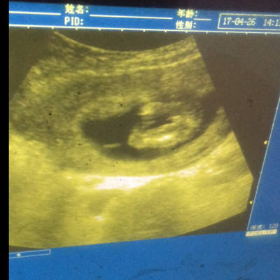三个月胎儿彩超图片