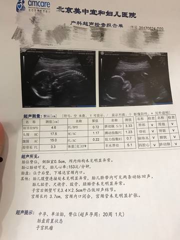 区3244 今天大排畸,各项指标都顺利通过了,就是宝宝太淘气不让看男女