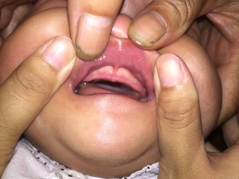 5个月半的宝宝牙龈大量出现白色