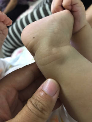 宝宝脚上有痣图解图片