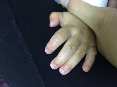 我家小孩现在十一个多月,这个手刚开始是红的简单脱皮,现在指甲都有点