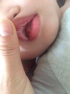 婴儿鹅口疮初期图片图片