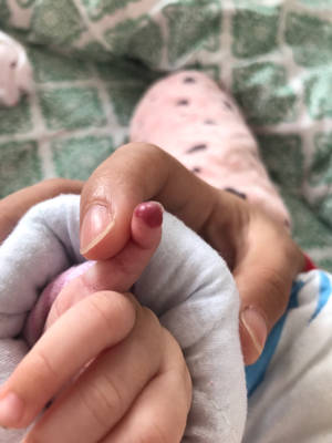 宝宝的小手指红肿怎麼办?