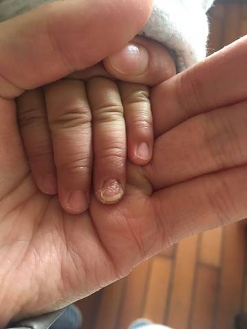 5岁儿童指甲扁平苔藓图片