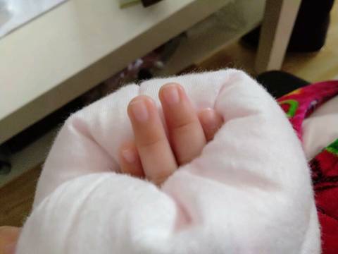 宝宝手指第一节发黄
