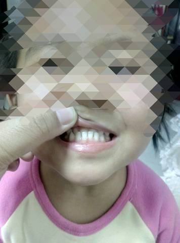 反颌的脸型图片儿童图片