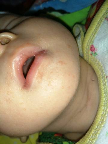 儿童嘴巴下巴起红疹子图片