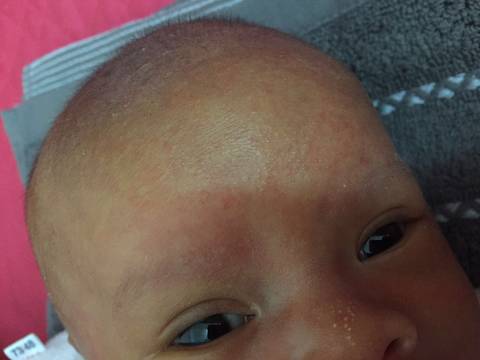 婴儿湿疹额头图片