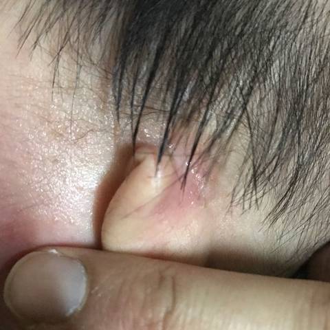 婴儿湿疹耳朵流脓图片图片