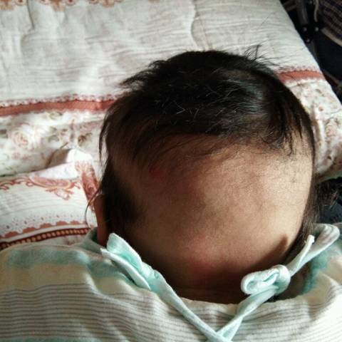 三个月婴儿枕秃图片图片