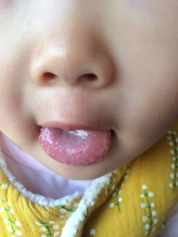 孩子舌头有小白点,咋回事